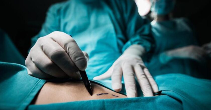 Liposuction Nedir, Nasıl Yapılır? Liposakşın Tedavisi Hangi Durumlarda Uygulanır?